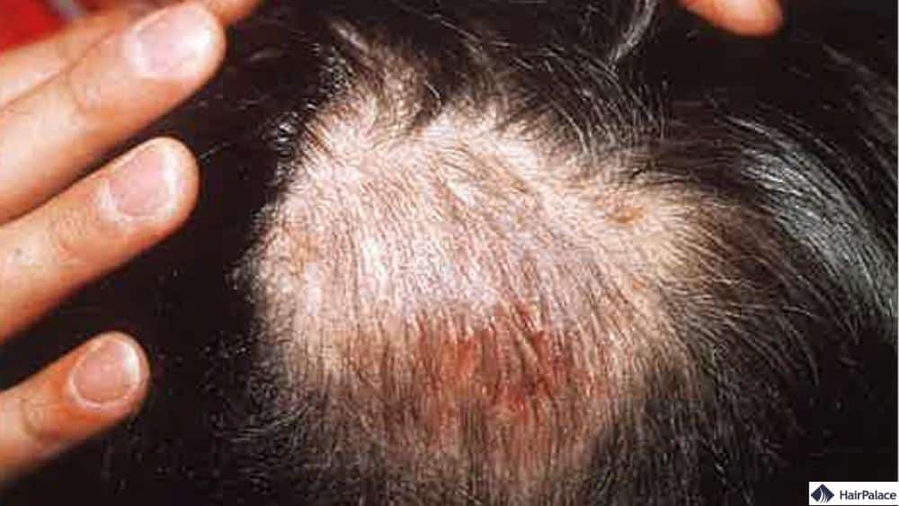 kopfhautpilz ursachen