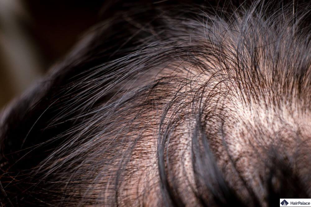 schmerzen der kopfhaut