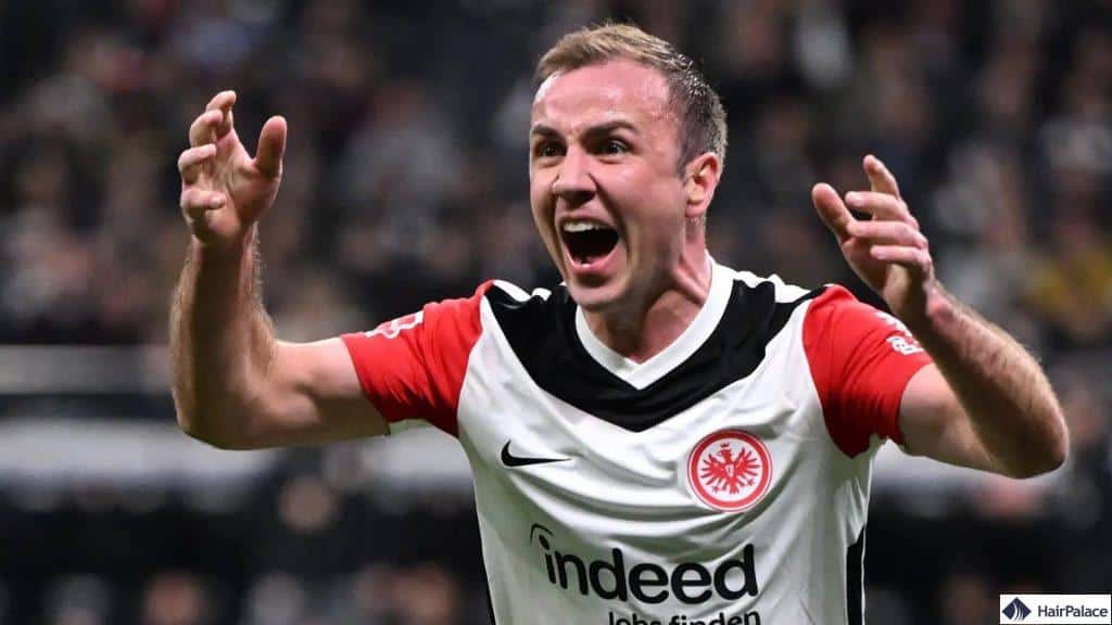 Mario Götze Glatze