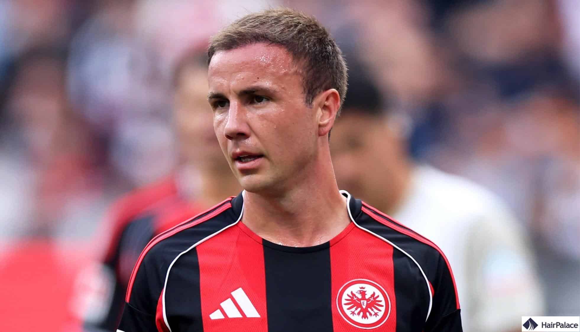 Gerüchte über eine Haartransplantation bei Mario Götze